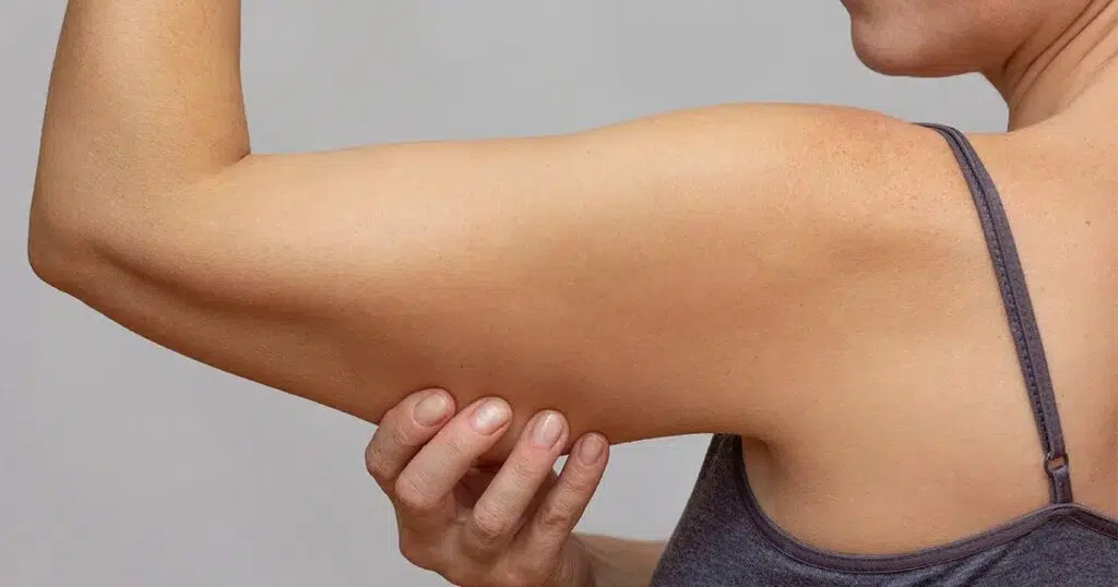 Woman gently holding the underside of her upper arm, showing healing and post-op tone following arm lift surgery.