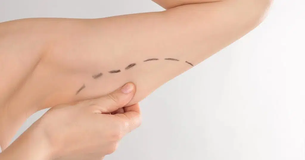 Woman pinching loose upper arm skin marked with a dashed incision line for an arm lift