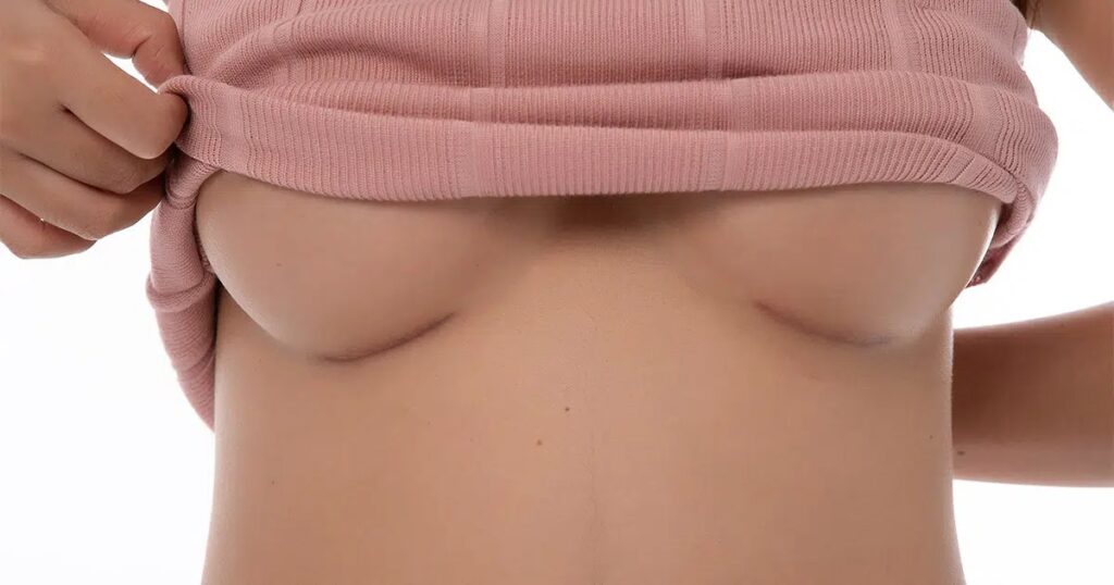 Close-up of a woman's lower breasts with visible post-surgical scars, illustrating breast surgery scarring.
