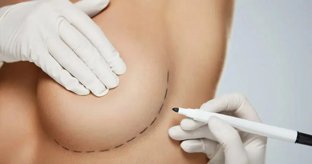 Gloved hands drawing pre-surgical markings on a patient's breast before implant revision surgery