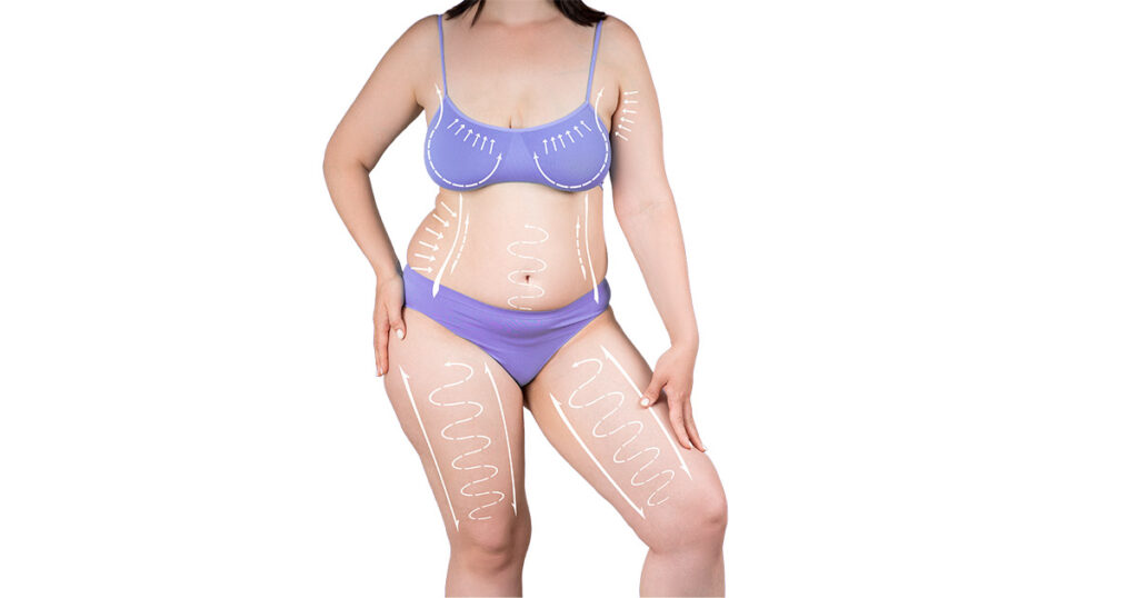 Woman in purple undergarments with white surgical markings on abdomen, thighs, and torso - illustrating areas treated in a circumferential body lift procedure.