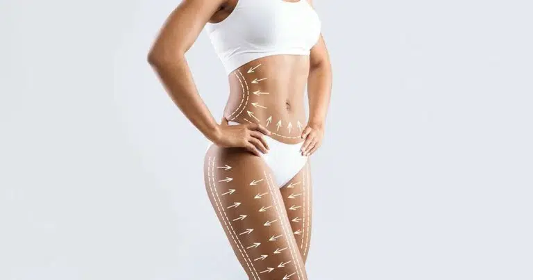 Woman’s midsection and thighs marked with contouring arrows and surgical guide lines, illustrating the targeted fat removal and sculpting areas for Lipo 360 and tummy tuck procedures.