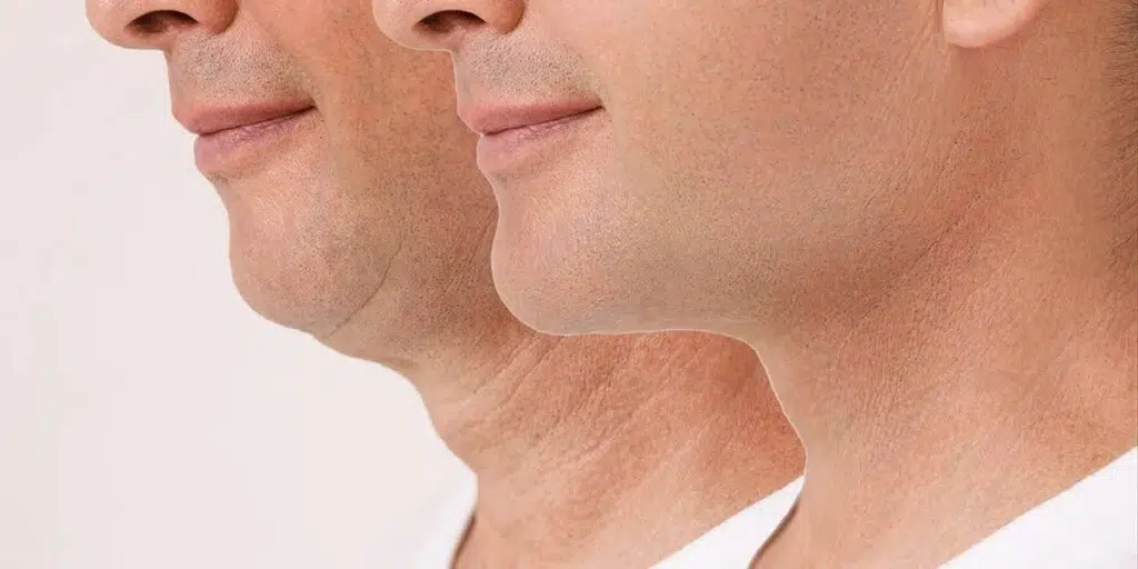 Before and after view of a neck lift on a man