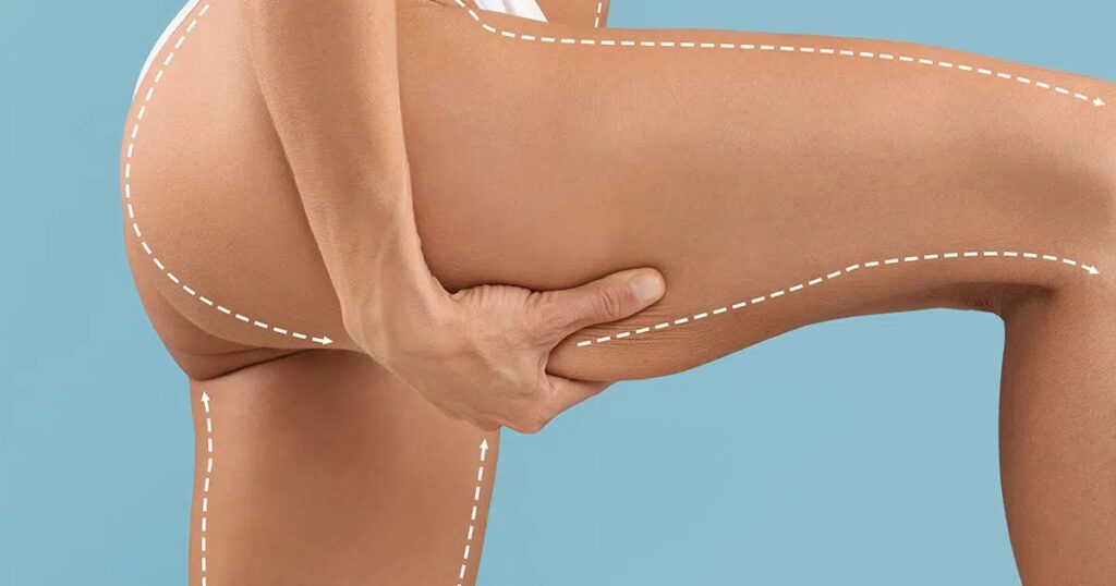 Close-up of a woman's thigh and lower body marked with dotted surgical lines, illustrating the typical treatment zones and preparation for thigh lift surgery.