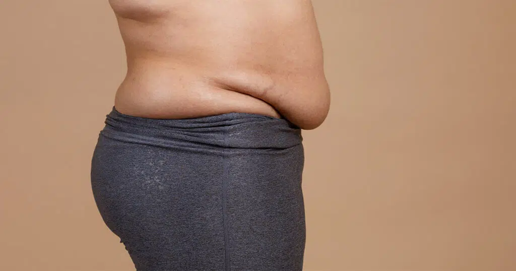 Side view of a person with excess abdominal skin and fat hanging over the waistline, commonly referred to as an apron belly or panniculus, often treated with panniculectomy or tummy tuck surgery.
