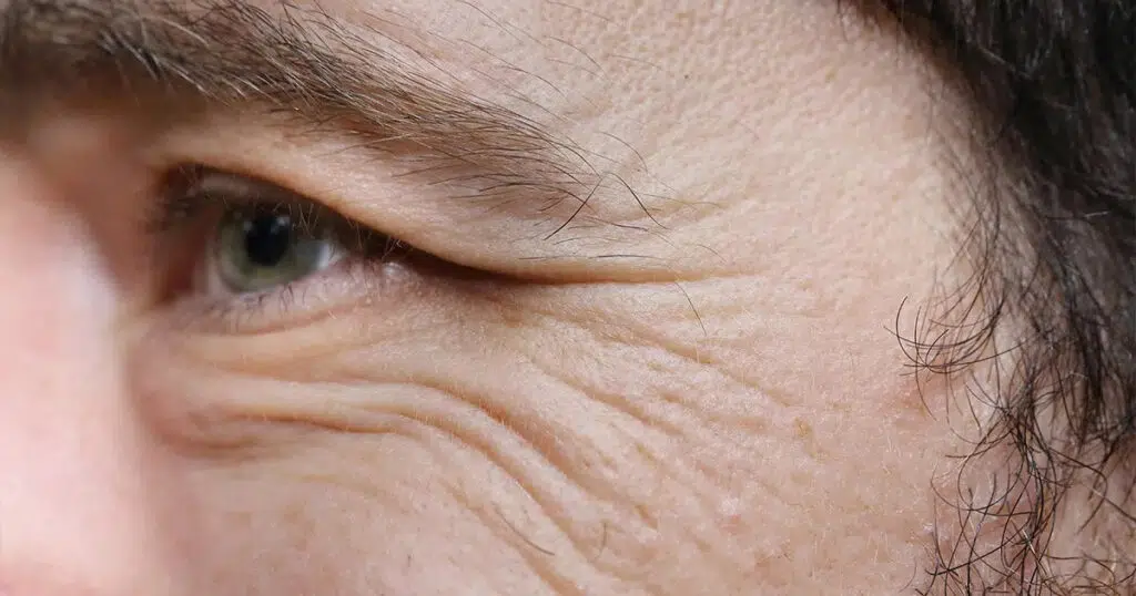 Close-up of a man's eye area showing crow's feet wrinkles at the outer corner of the eye.