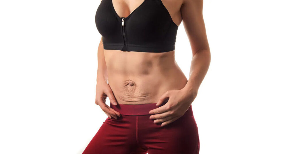 Woman showing abdominal area with loose skin, wearing a black sports bra and red leggings, illustrating diastasis recti recovery.