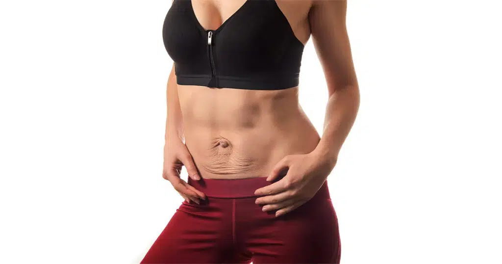 Woman showing abdominal area with loose skin, wearing a black sports bra and red leggings, illustrating diastasis recti recovery.