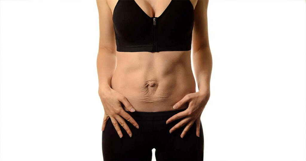 Woman with Diastasis Recti