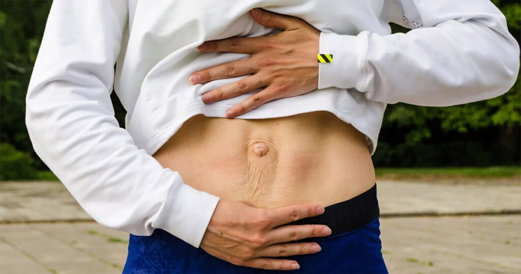 Person with Diastasis Recti