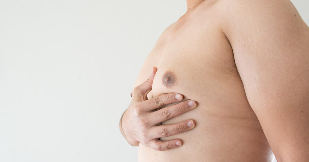 Close-up of a man's chest with visible breast tissue, as he holds the area with his hand - commonly associated with gynecomastia, a condition graded by severity to determine treatment options.
