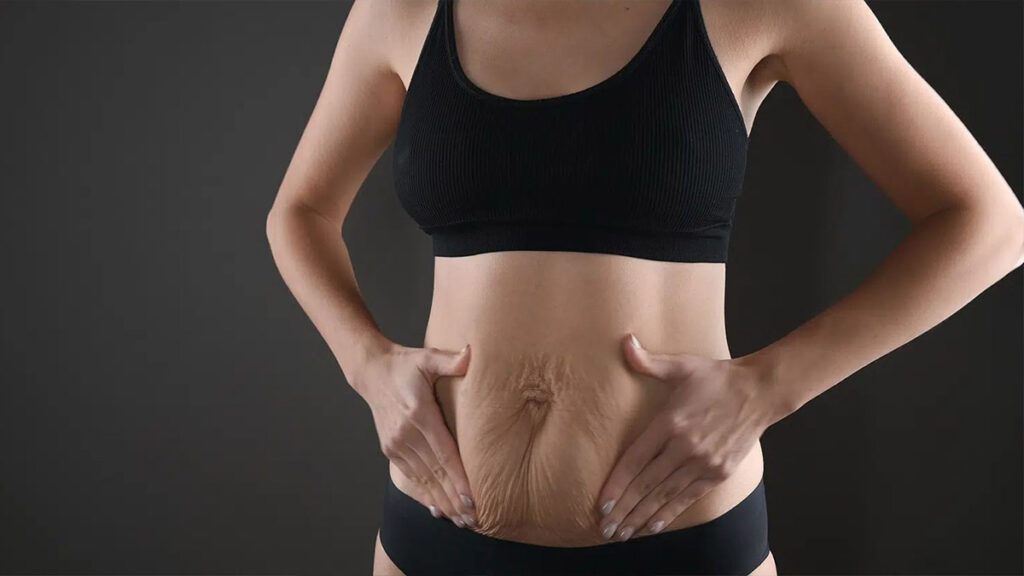 Woman with loose skin around her abdomen
