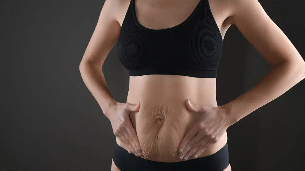 Woman with loose skin around her abdomen