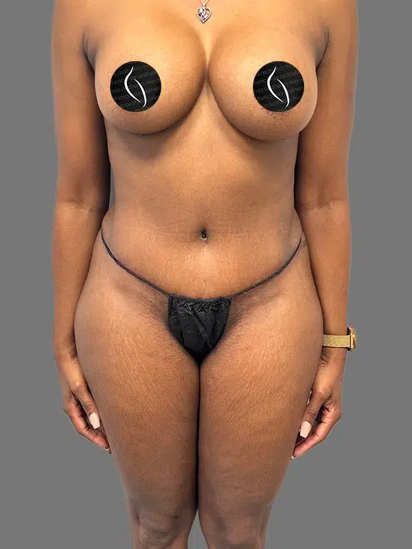 Tummy Tuck after photo – Mia Aesthetics