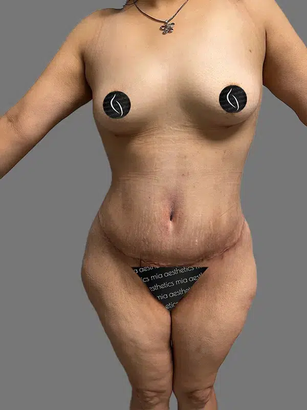 Tummy Tuck after photo – Mia Aesthetics