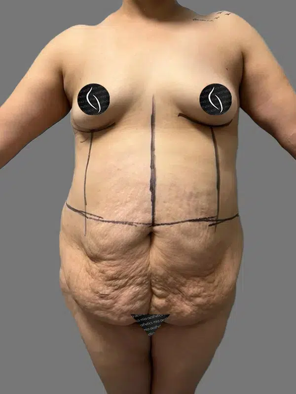 Tummy Tuck before photo – Mia Aesthetics