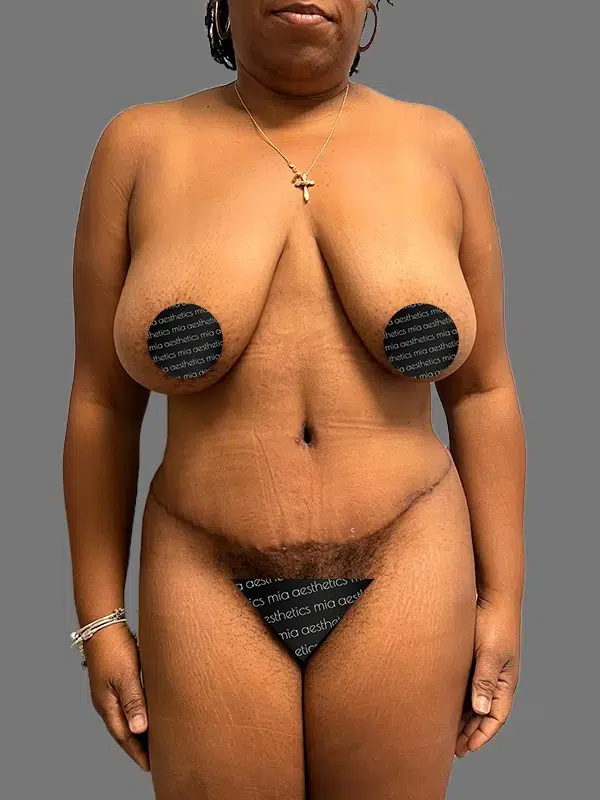Tummy Tuck after photo – Mia Aesthetics
