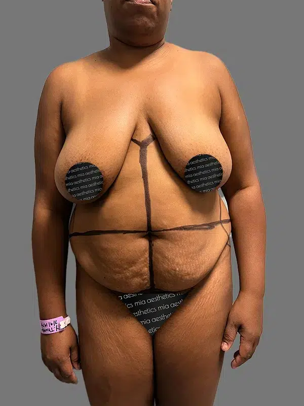 Tummy Tuck before photo – Mia Aesthetics