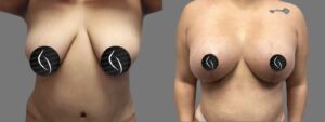 Case 1999 – Breast Lift with Silicone Implants