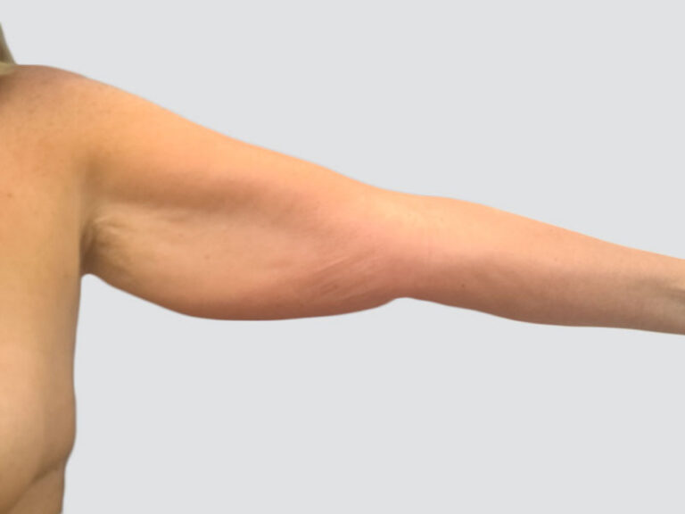 Before Treatment – Case 6006 – Arm Lift