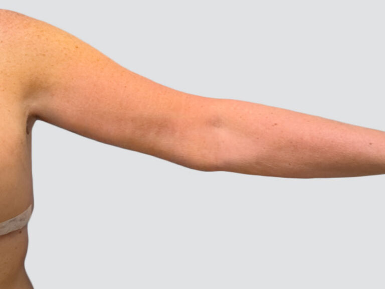 After Treatment – Case 6006 – Arm Lift