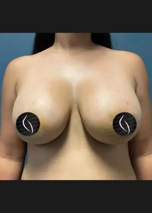 After procedure