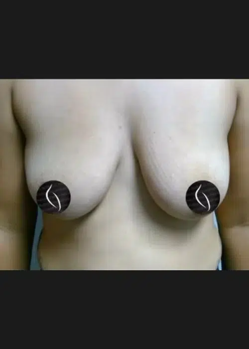 Before procedure