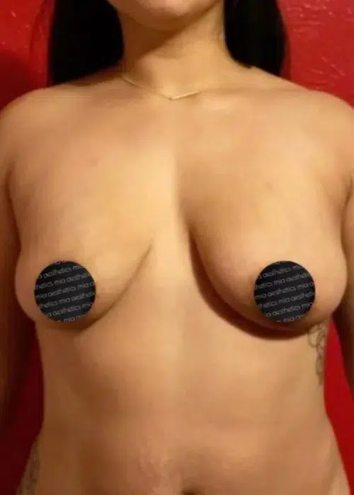 Before procedure