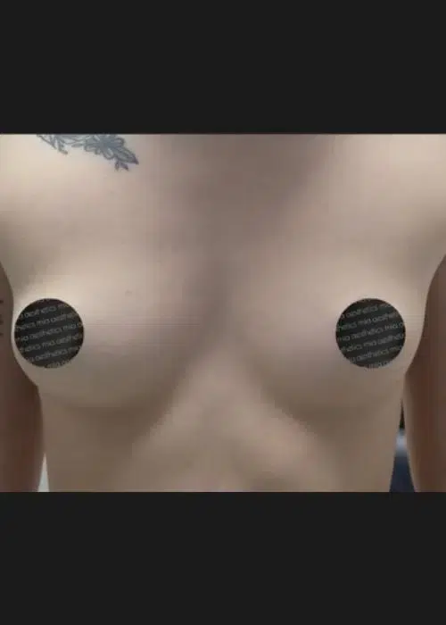 Before procedure