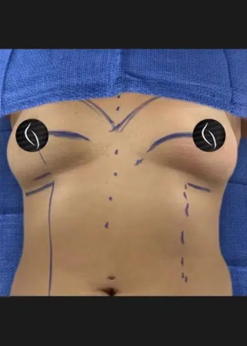 Before procedure