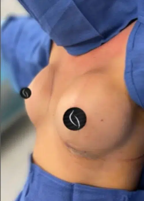 After procedure
