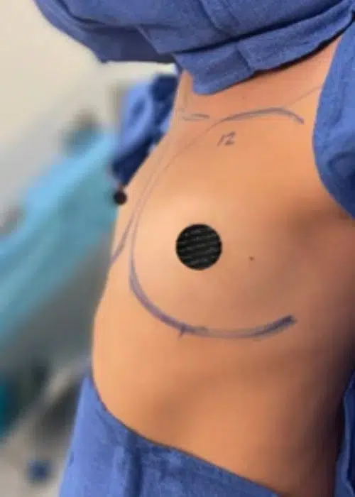 Before procedure