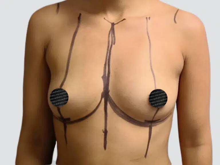 Breast Augmentation before photo – Mia Aesthetics