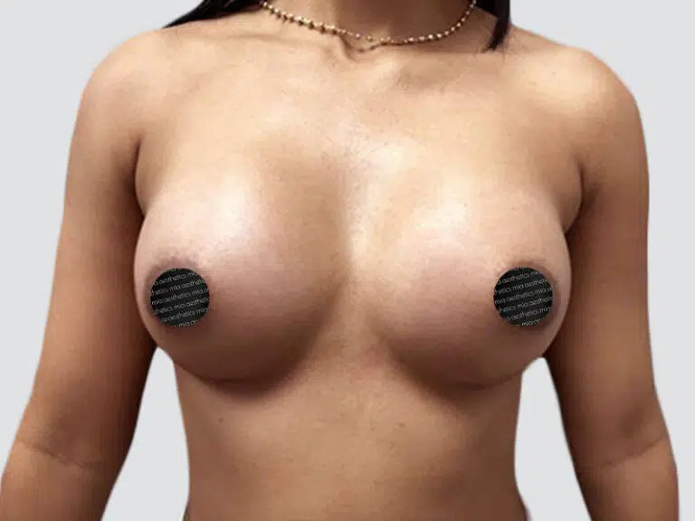 Breast Augmentation after photo – Mia Aesthetics