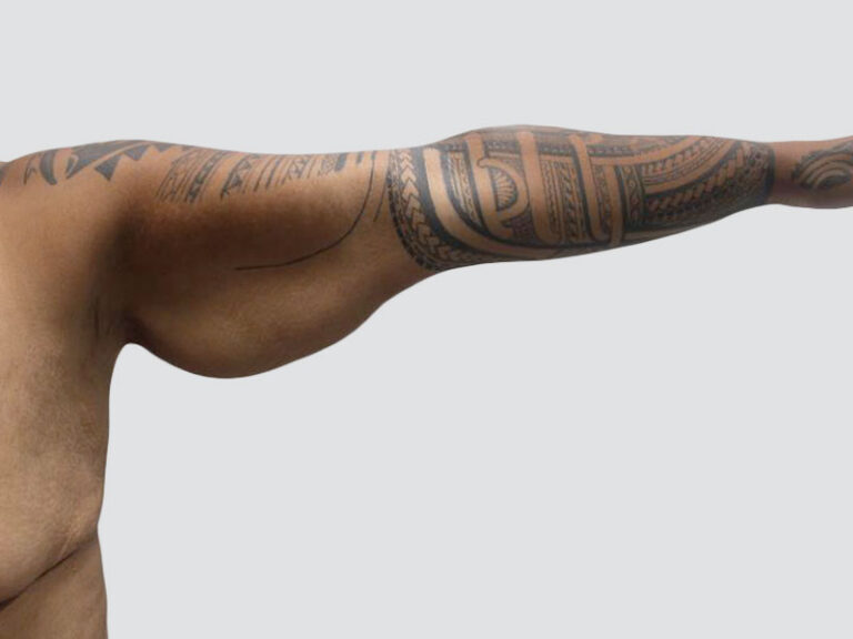 Before Treatment – Case 6003 – Arm Lift