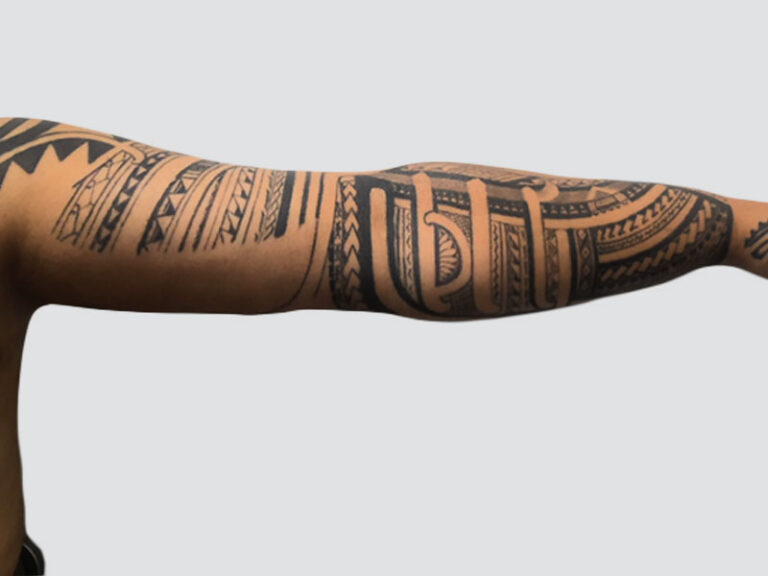 After Treatment – Case 6003 – Arm Lift