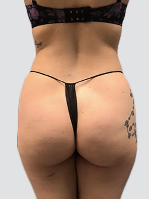 Brazilian Butt Lift (BBL) before photo – Mia Aesthetics
