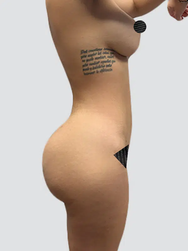 Brazilian Butt Lift (BBL) after photo – Mia Aesthetics