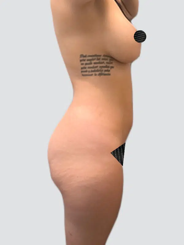 Brazilian Butt Lift (BBL) before photo – Mia Aesthetics
