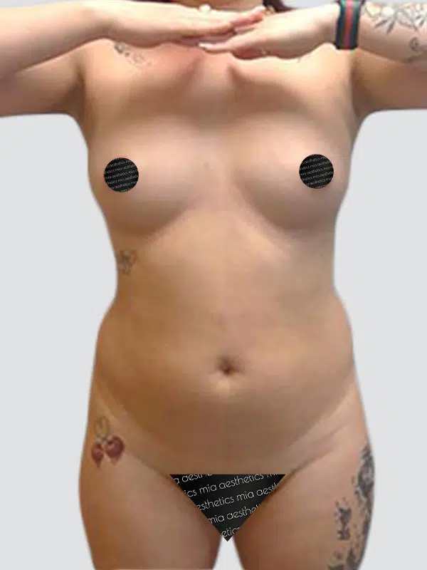 Mommy Makeover before photo – Mia Aesthetics