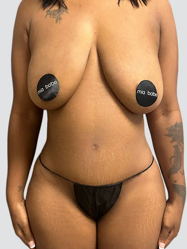 Tummy Tuck after photo – Mia Aesthetics