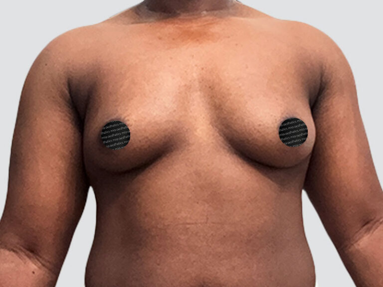 Before Treatment – Case 2018 – Breast Augmentation