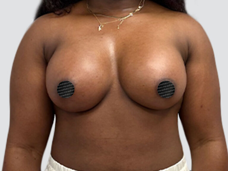 After Treatment – Case 2018 – Breast Augmentation