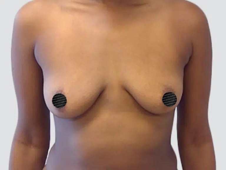 Breast Augmentation before photo – Mia Aesthetics