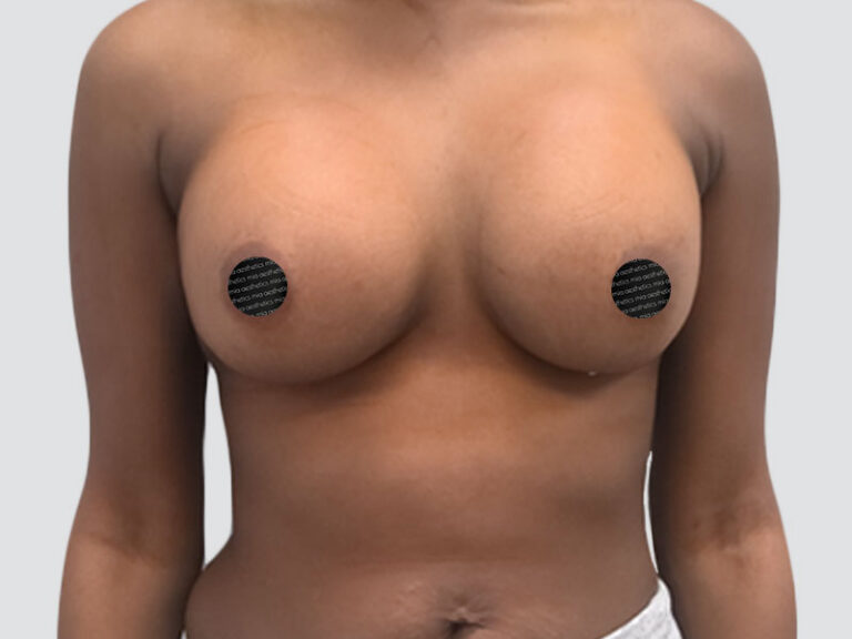 After Treatment – Case 2019 – Breast Augmentation