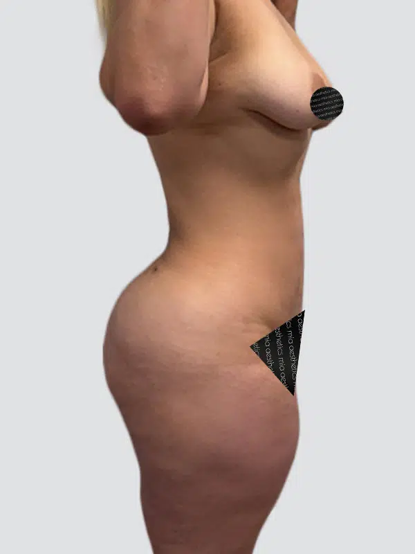 Lipo 360 after photo – Mia Aesthetics