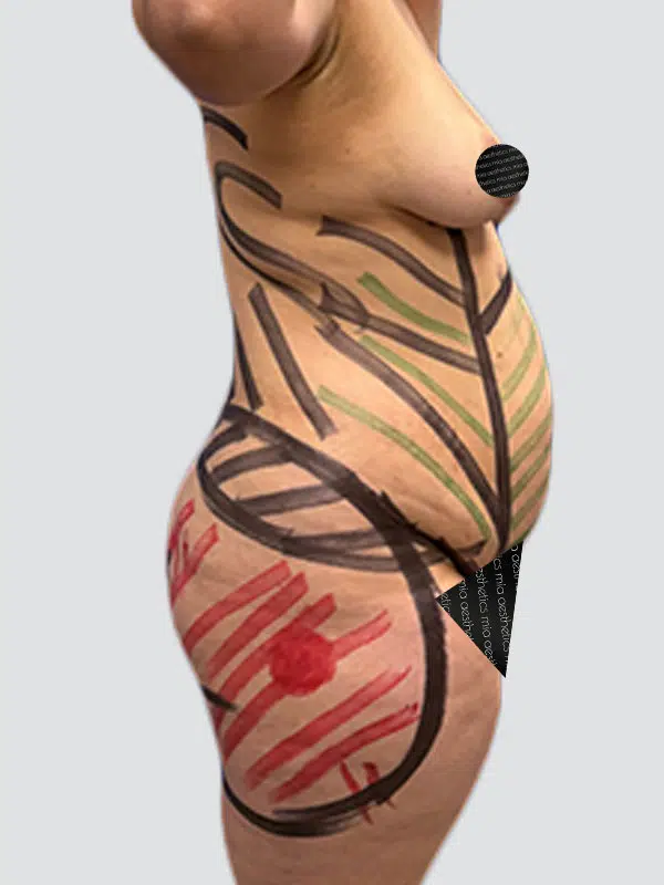Lipo 360 before photo – Mia Aesthetics