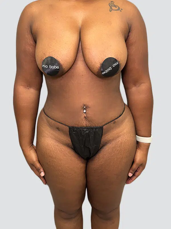 Lipo 360 after photo – Mia Aesthetics