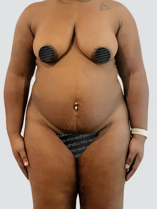 Lipo 360 before photo – Mia Aesthetics