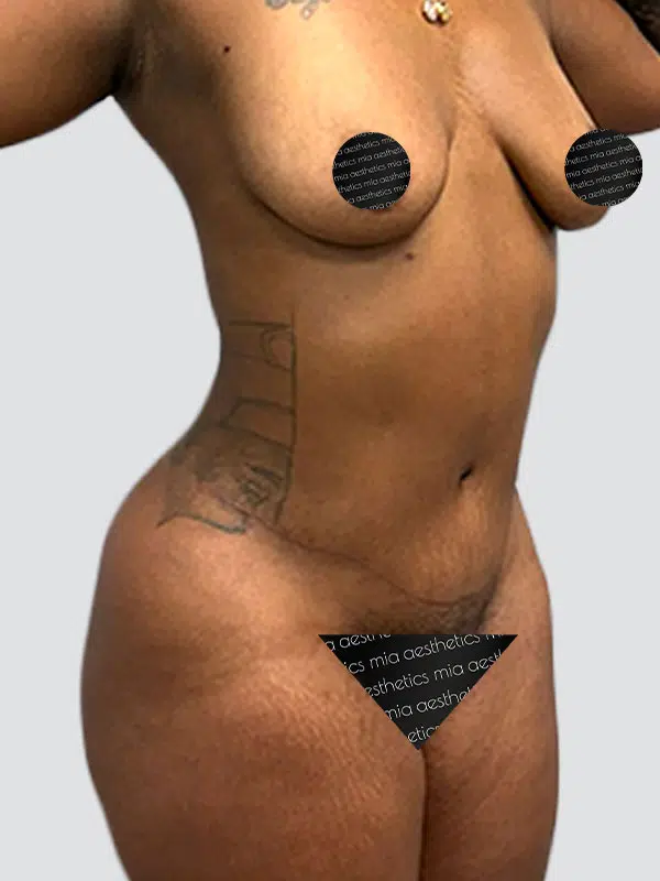 Tummy Tuck after photo – Mia Aesthetics